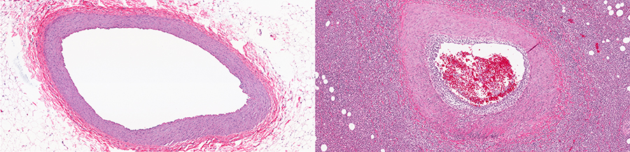 Gefäßverengung in den Arterien